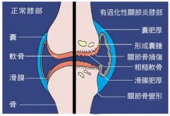 当心退化性关节炎