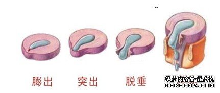 颈椎间盘膨出症状如何?