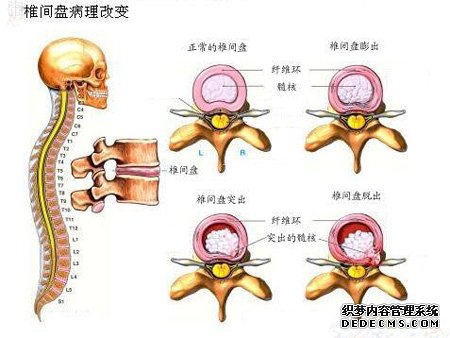 颈椎间盘膨出症状如何?