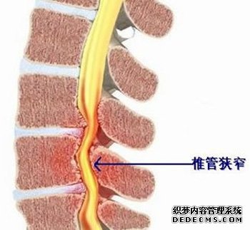 颈椎管狭窄哪儿治得好?