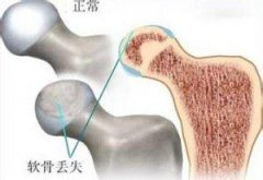 不开刀，不手术，不换股骨头——五位一体疗法