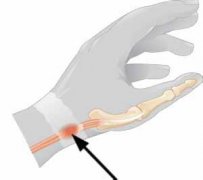 手腕死精的治疗方法——激光针刀松解术